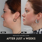 ReSculpt Facial Sculptor™