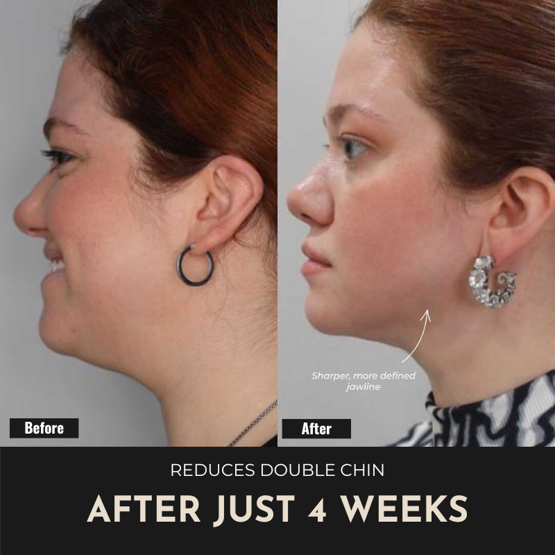 ReSculpt Facial Sculptor™