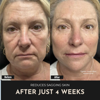 ReSculpt Facial Sculptor™