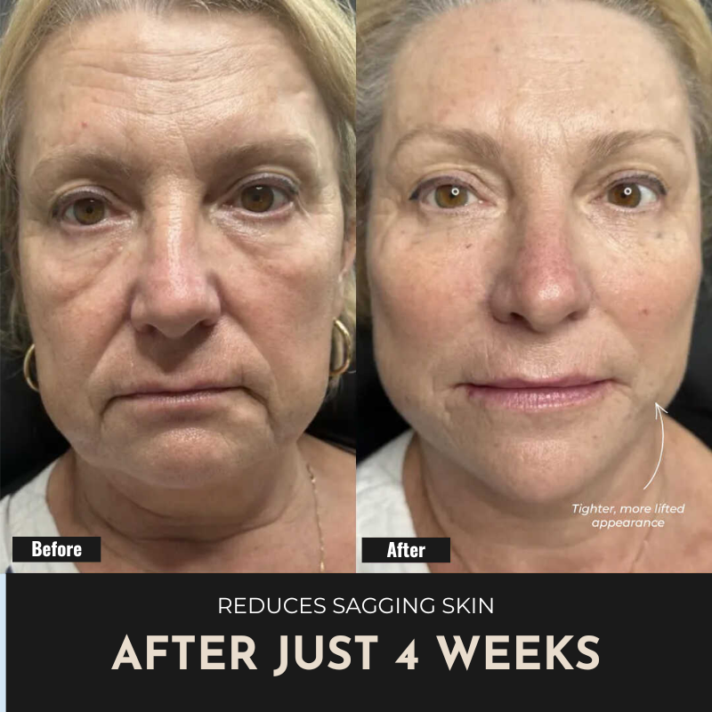 ReSculpt Facial Sculptor™